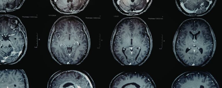 What Causes Alcohol Withdrawal in the Body?