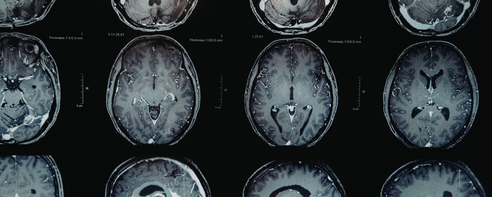 What Causes Alcohol Withdrawal in the Body?